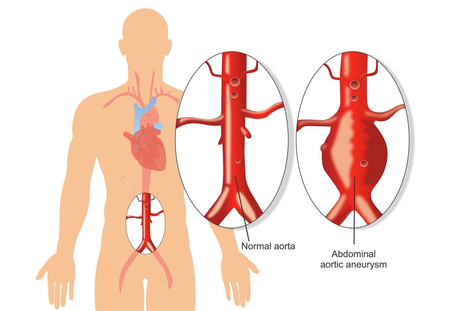 Aortic Aneurysm Treatment in Banashankari