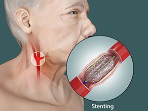 Carotid Artery Stenosis Treatment in  in jayanagar