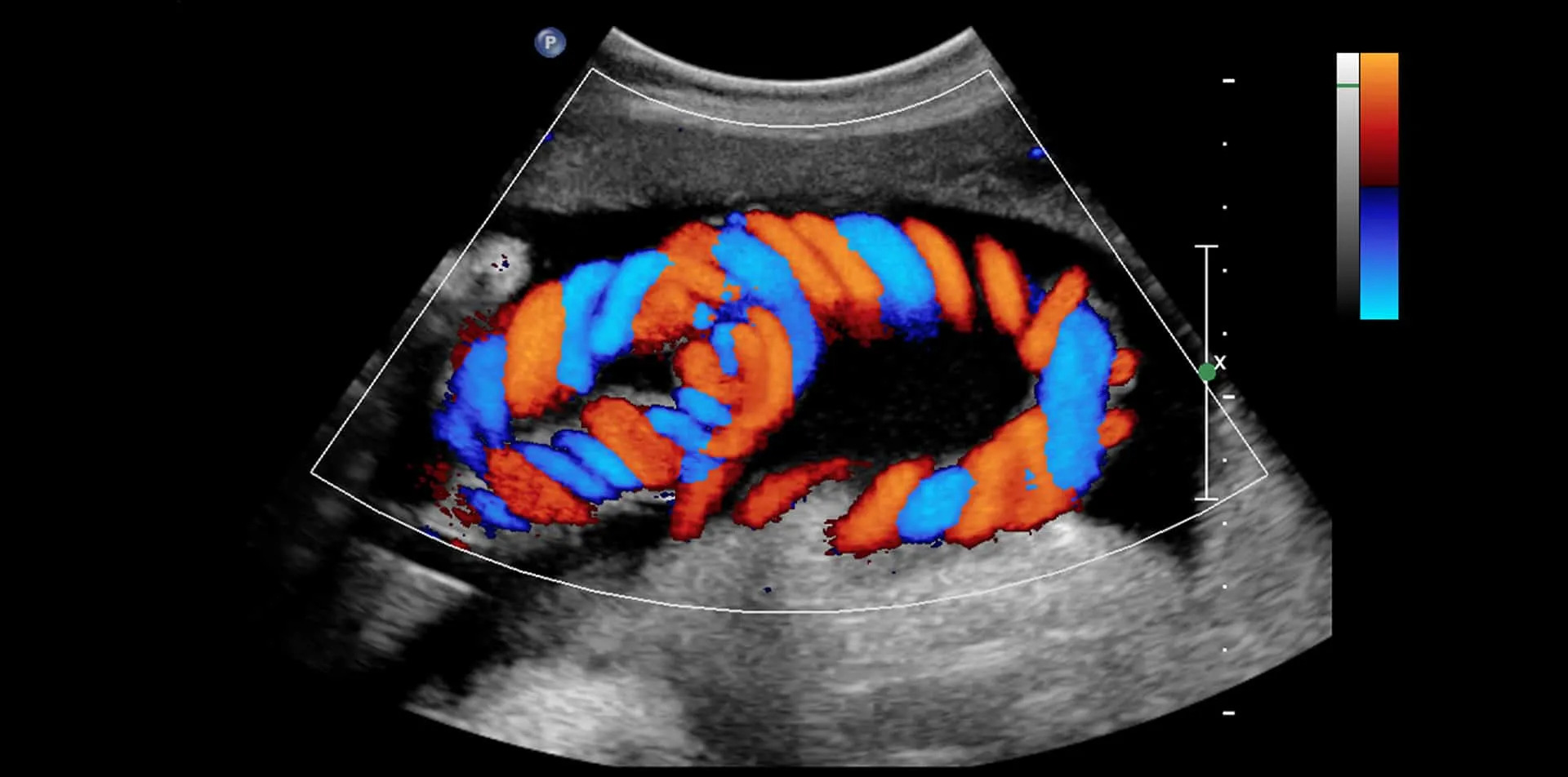 Color Doppler