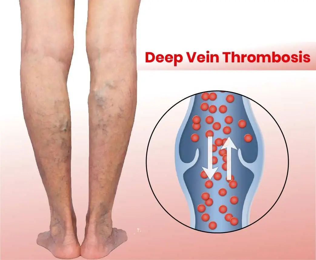 Deep Vein Thrombosis Treatment in jayanagar