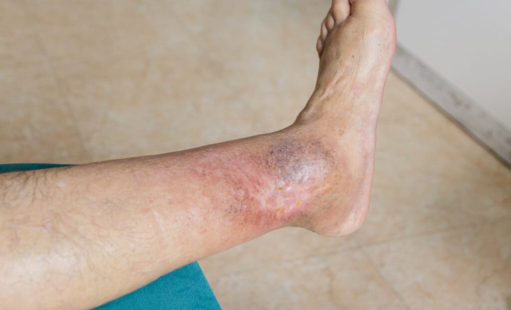 Leg Ulcer Treatment in Jp Nagar