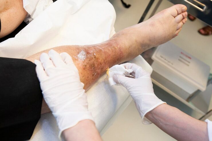 Leg swelling treatment in hsr Layout